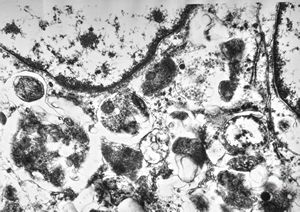 M, 38y. | granular cell tumor M, 38y. | granular cell tumor